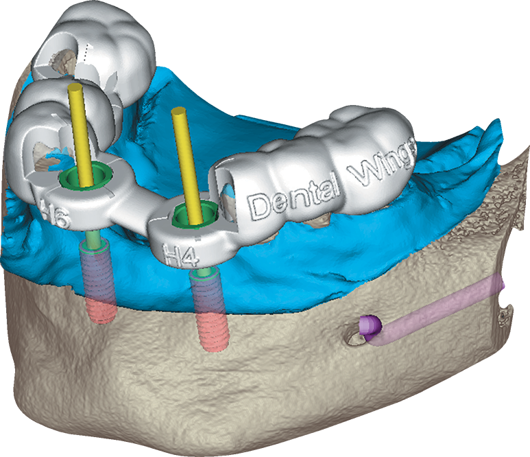 Chirurgie guidée - Dental Wings Chirurgie guidée - Dental Wings