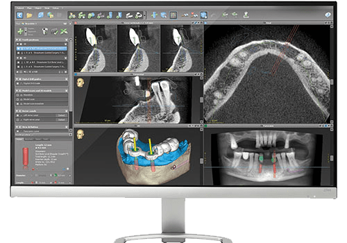 La position optimale de l’implant se fait avec coDiagnostiX et la conception du guide chirurgial se fait avec DWOS.