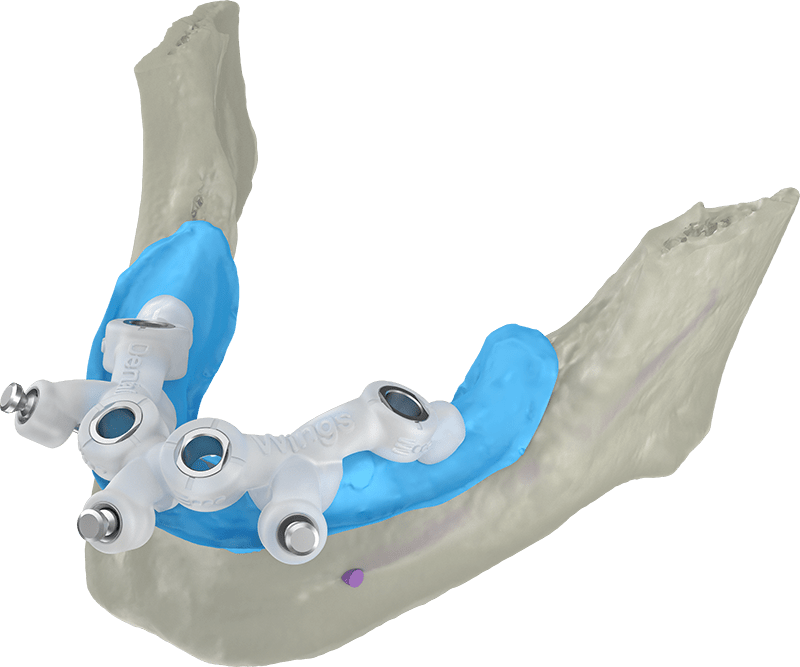 coDiagnostiX - lateralpins complete coDiagnostiX - lateralpins complete