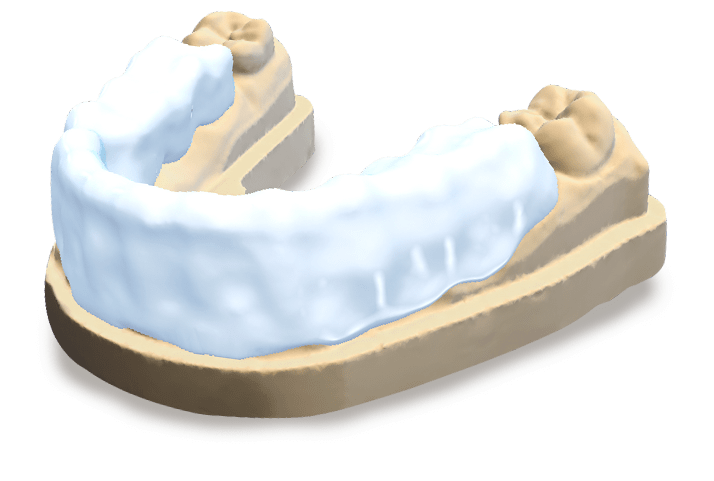 DWOS Bite Splints - Dental Wings DWOS Bite Splints - Dental Wings