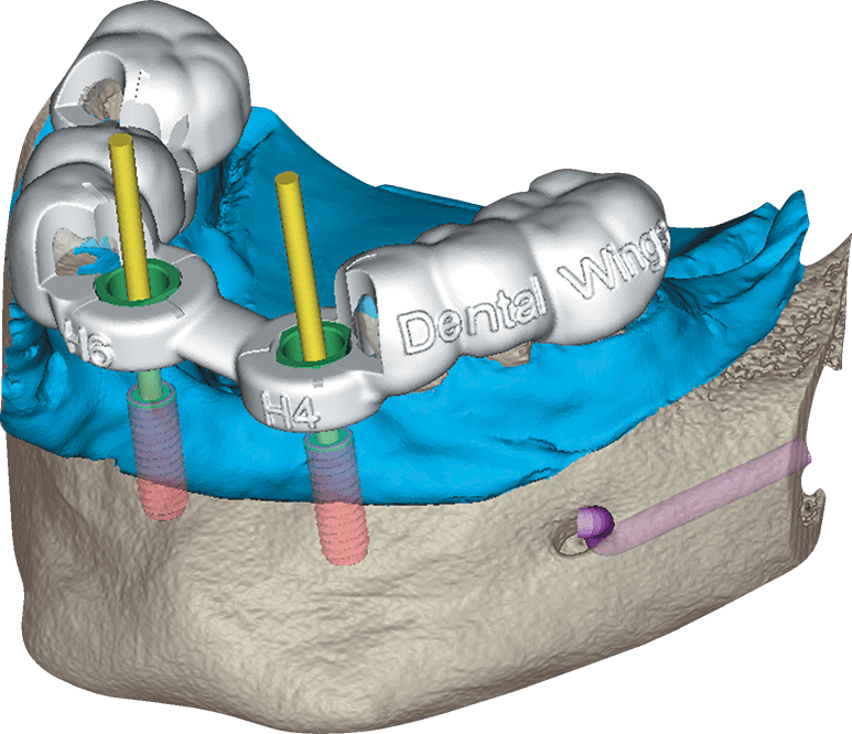 DWOS Chirurgia Guidata - Dental Wings DWOS Chirurgia Guidata - Dental Wings