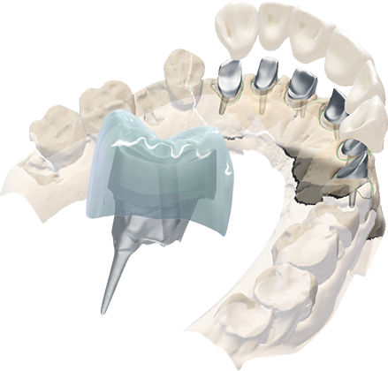 DWOS Corone e ponti - Dental Wings DWOS Corone e ponti - Dental Wings