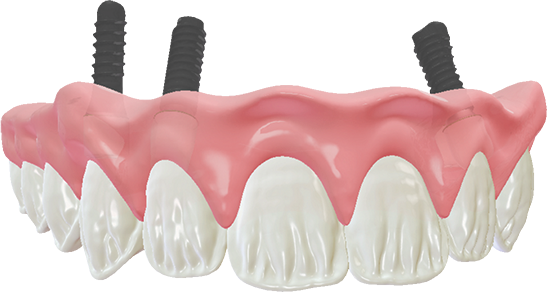 DWOS Protesi implantare - Dental Wings DWOS Protesi implantare - Dental Wings