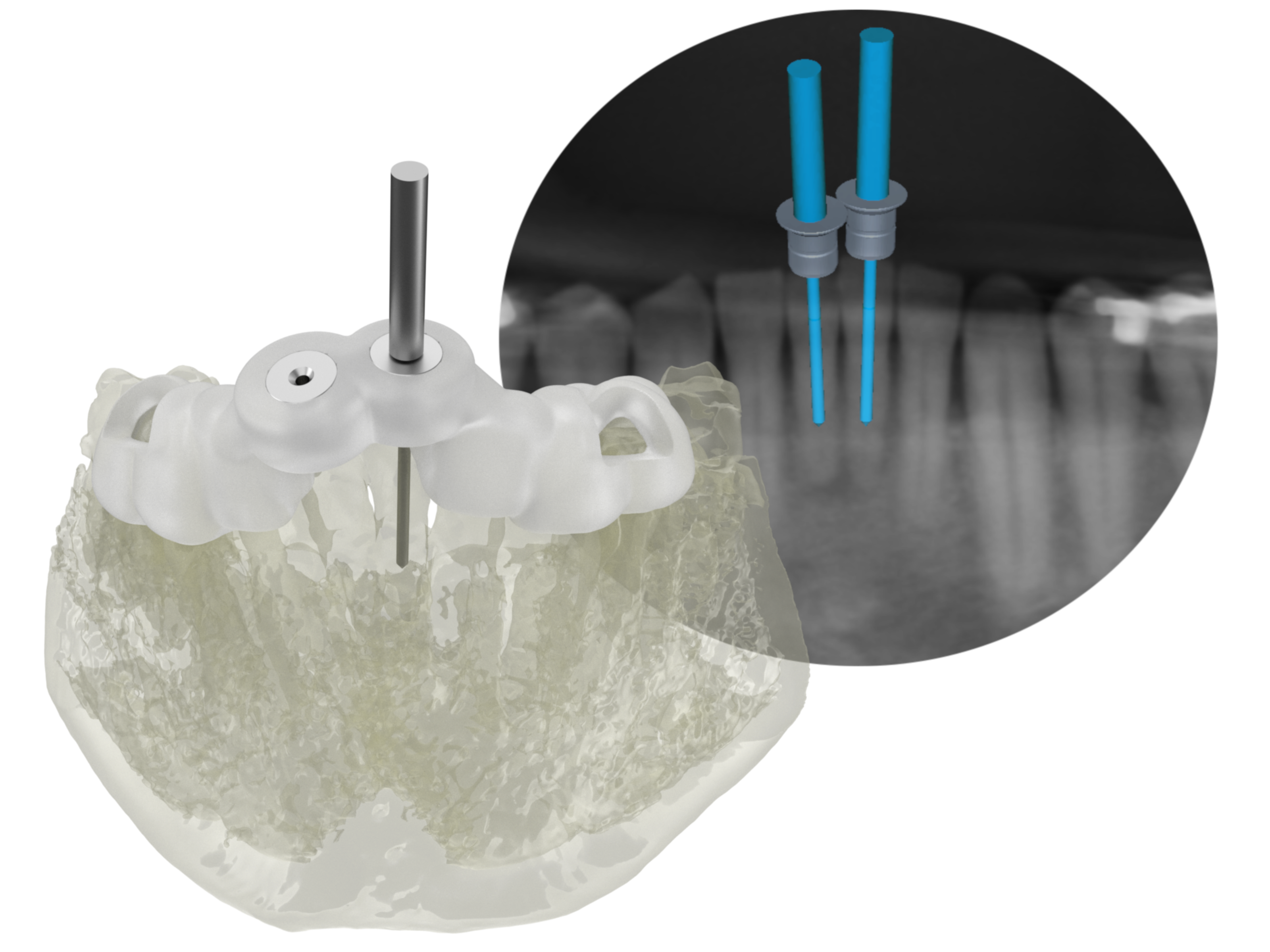 endodontic systems