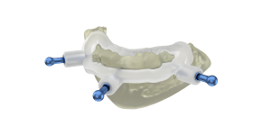coDiagnostiX bone reduction guide